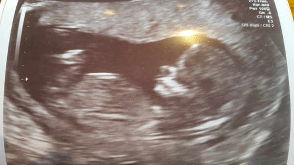 13wk scan today any guesses?