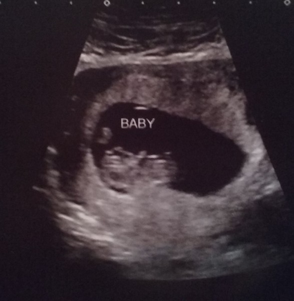 September 2016 (Thread 2) Booking in and 12 weeks scans soon!