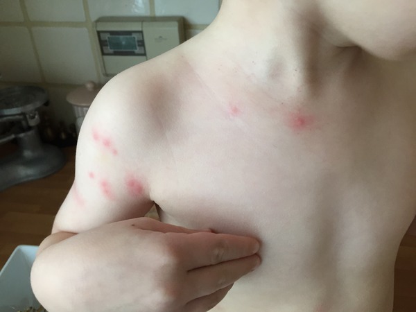 chicken pox?