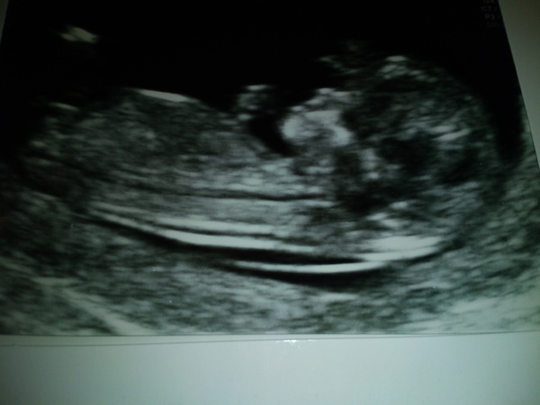 August 2016 (3) - scans fast approaching, teeny tiny bumps appearing, and sickness easing....we hope!