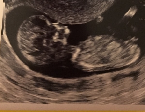 September 2016 (Thread 2) Booking in and 12 weeks scans soon!