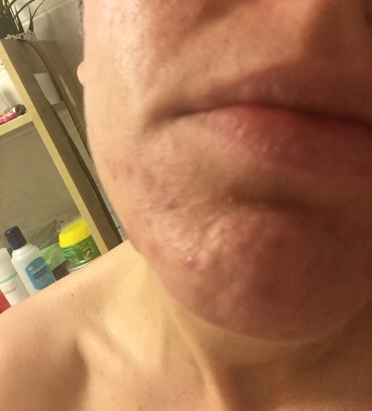 Advice for those with acne with pics