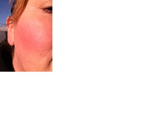 Regreting dermaplaning
