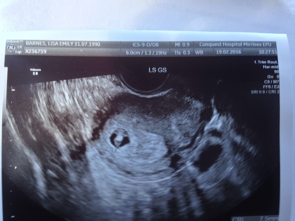 Empty gestational sac at 5+3