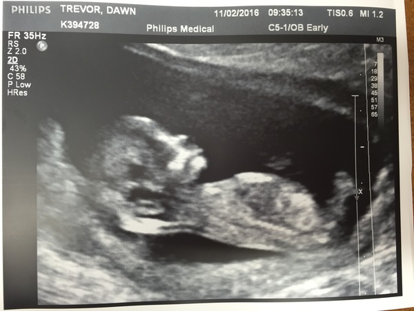 August 2016 (3) - scans fast approaching, teeny tiny bumps appearing, and sickness easing....we hope!