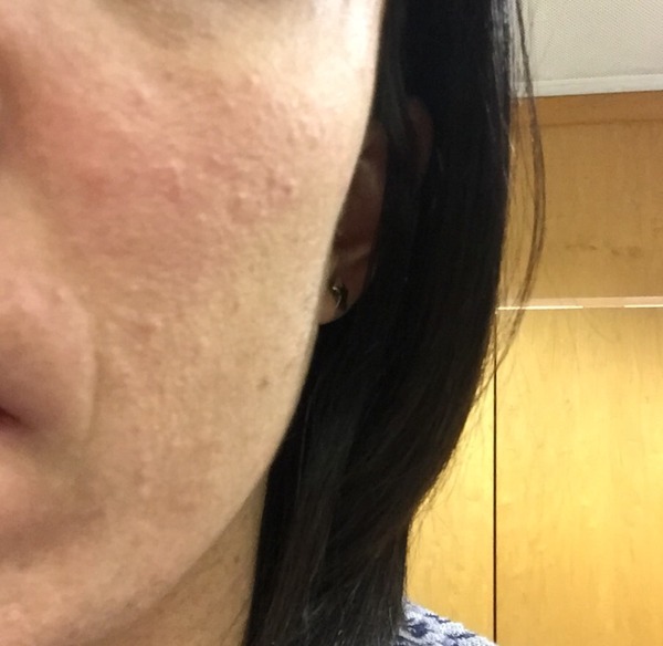What are these pimply bumps on my face?