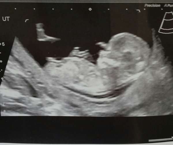 August 2016 (3) - scans fast approaching, teeny tiny bumps appearing, and sickness easing....we hope!