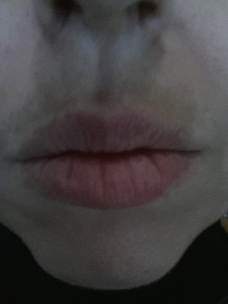Help Please: Melasma (?)+ Redness around Nose and Mouth Area