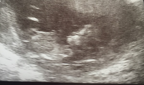 September 2016 (Thread 2) Booking in and 12 weeks scans soon!