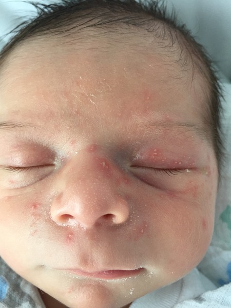 Baby acne or something else??? Please advise