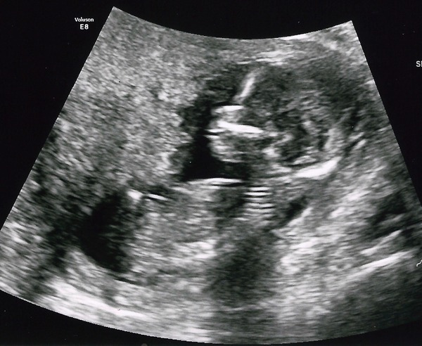 August 2016 (3) - scans fast approaching, teeny tiny bumps appearing, and sickness easing....we hope!