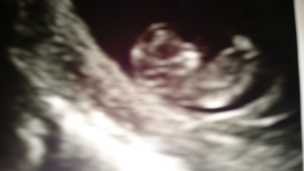 September 2016 (Thread 2) Booking in and 12 weeks scans soon!