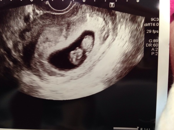 Staying posifrickentive - Thread 7 for ladies pregnant after mc