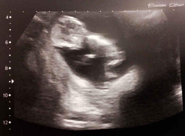 12 week scan tomorrow