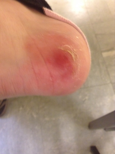 Ringworm