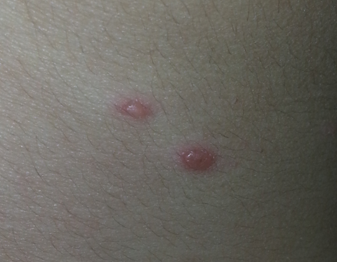 DD has suspected chickenpox - do I miss my fitness class tonight?