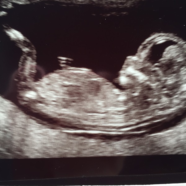 August 2016 (3) - scans fast approaching, teeny tiny bumps appearing, and sickness easing....we hope!