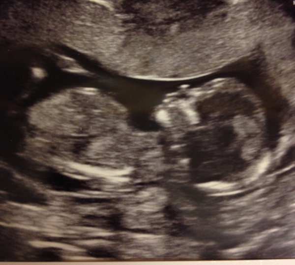 13 week scan..any guesses?