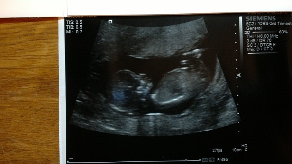 September 2016 (Thread 2) Booking in and 12 weeks scans soon!