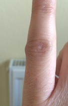 Lump on finger?