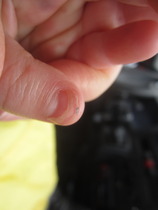 Extreme nail biting