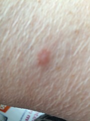 Photo inc - should mum get this checked? Prior sunbed use 10+ years ago