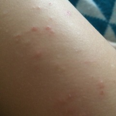 Itchy small spots on 19 mth old , eczema ? Advice needed