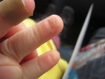 Extreme nail biting