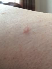 Photo inc - should mum get this checked? Prior sunbed use 10+ years ago