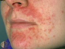 Has anyone had & cured dermatitis?
