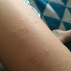 Itchy small spots on 19 mth old , eczema ? Advice needed