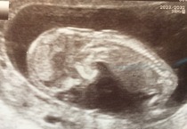 August 2016 (3) - scans fast approaching, teeny tiny bumps appearing, and sickness easing....we hope!