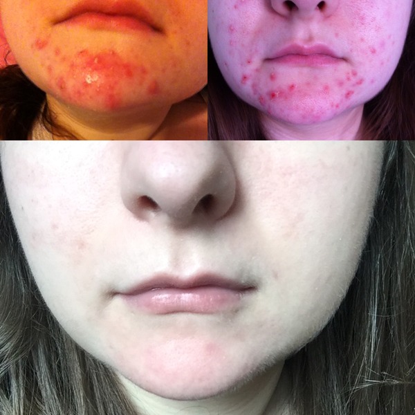 Advice for those with acne with pics