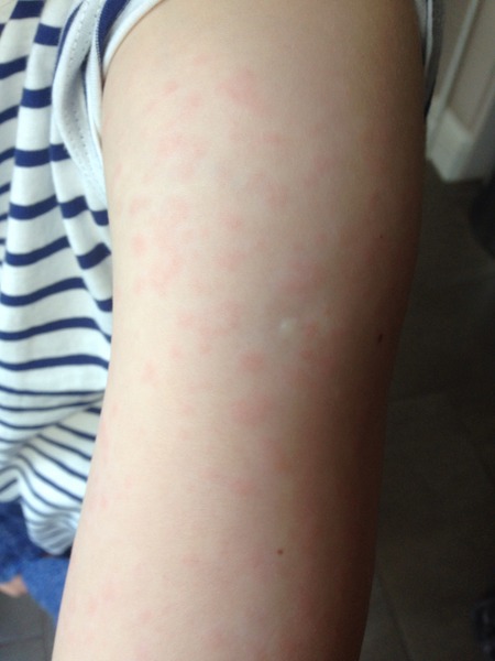 Anyone able to diagnose this rash? (Pics)