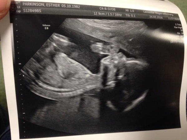 August 2016 number 4 - bumps popping and scans happening, we actually have babies!