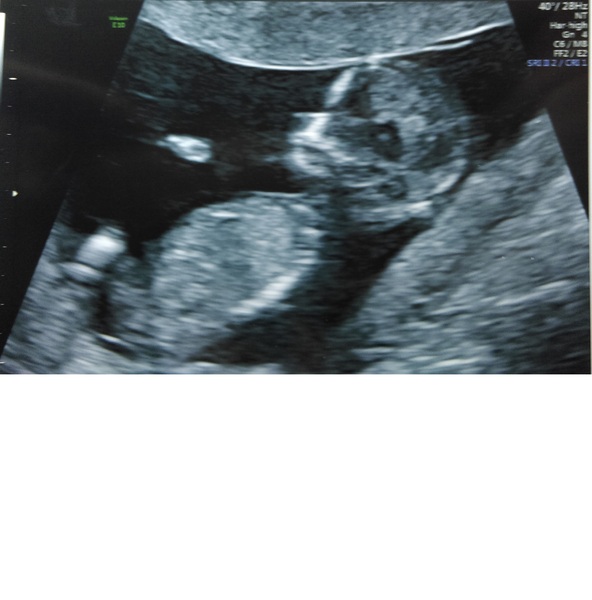 September 2016 (Thread 2) Booking in and 12 weeks scans soon!