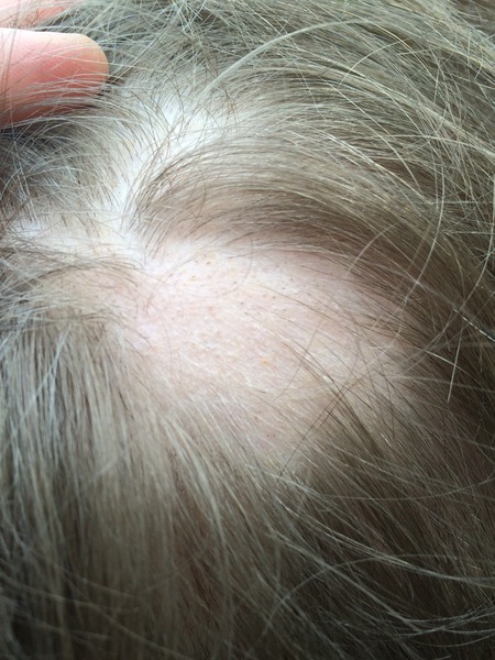 Alopecia Areata - Anyone have any experience? 10 yo DS