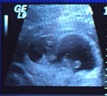 Forty and over trying for a first baby - join us here