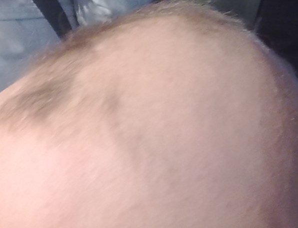 Alopecia Areata - Anyone have any experience? 10 yo DS