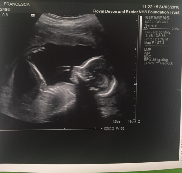 August 2016 number 4 - bumps popping and scans happening, we actually have babies!