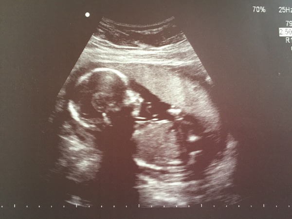 August 2016 number 4 - bumps popping and scans happening, we actually have babies!