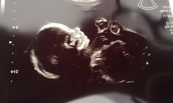 August 2016 number 4 - bumps popping and scans happening, we actually have babies!