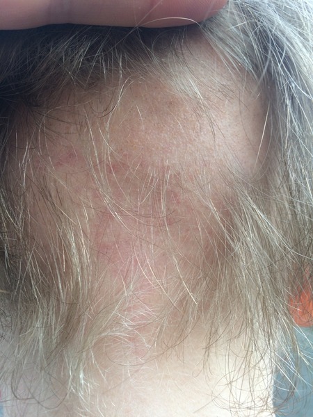 Alopecia Areata - Anyone have any experience? 10 yo DS
