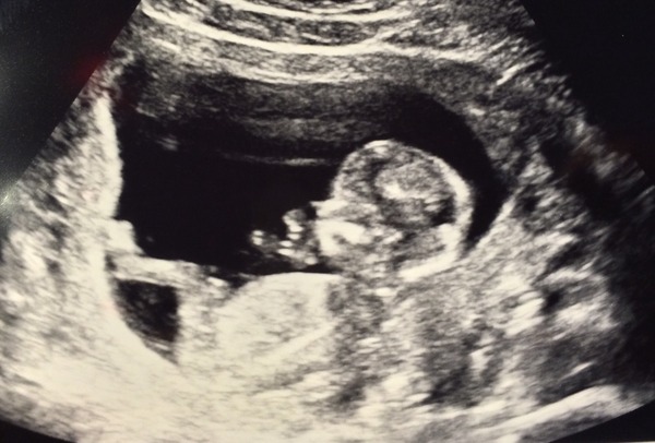 September 2016 (Thread 2) Booking in and 12 weeks scans soon!