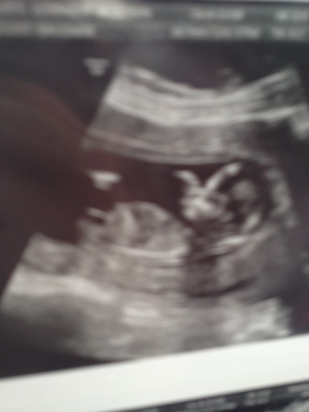 August 2016 number 4 - bumps popping and scans happening, we actually have babies!