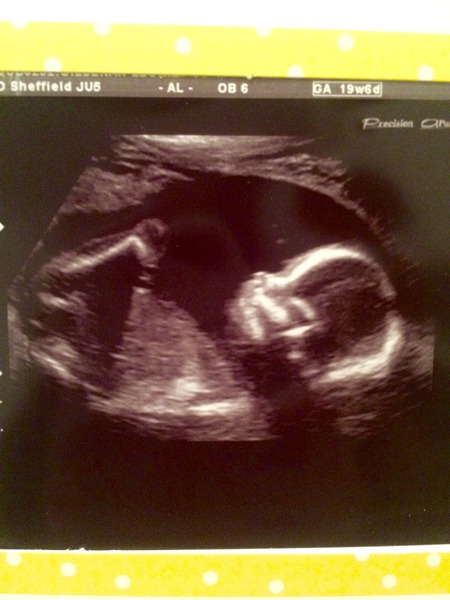 August 2016 number 4 - bumps popping and scans happening, we actually have babies!