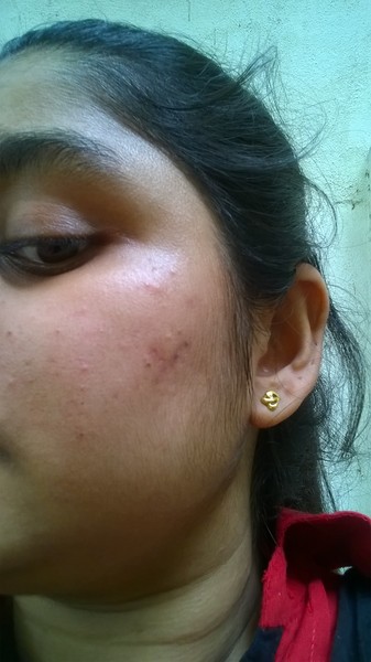 pockmarks