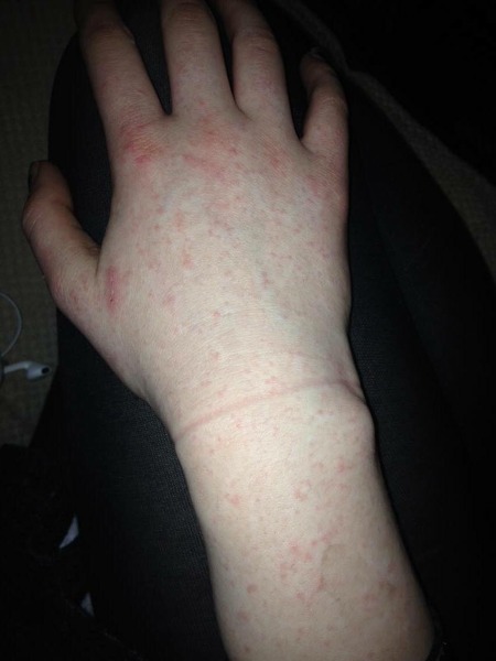Any idea what's causing DD16's rash? (Pic included)