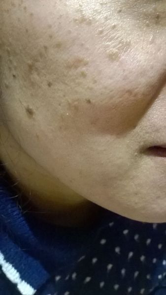 Help Please: Melasma (?)+ Redness around Nose and Mouth Area