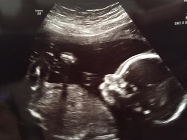 21 week scan. Any guesses on baby's sex? :)